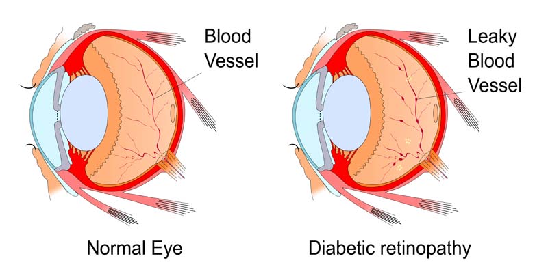 Diabetic Retinoppathy